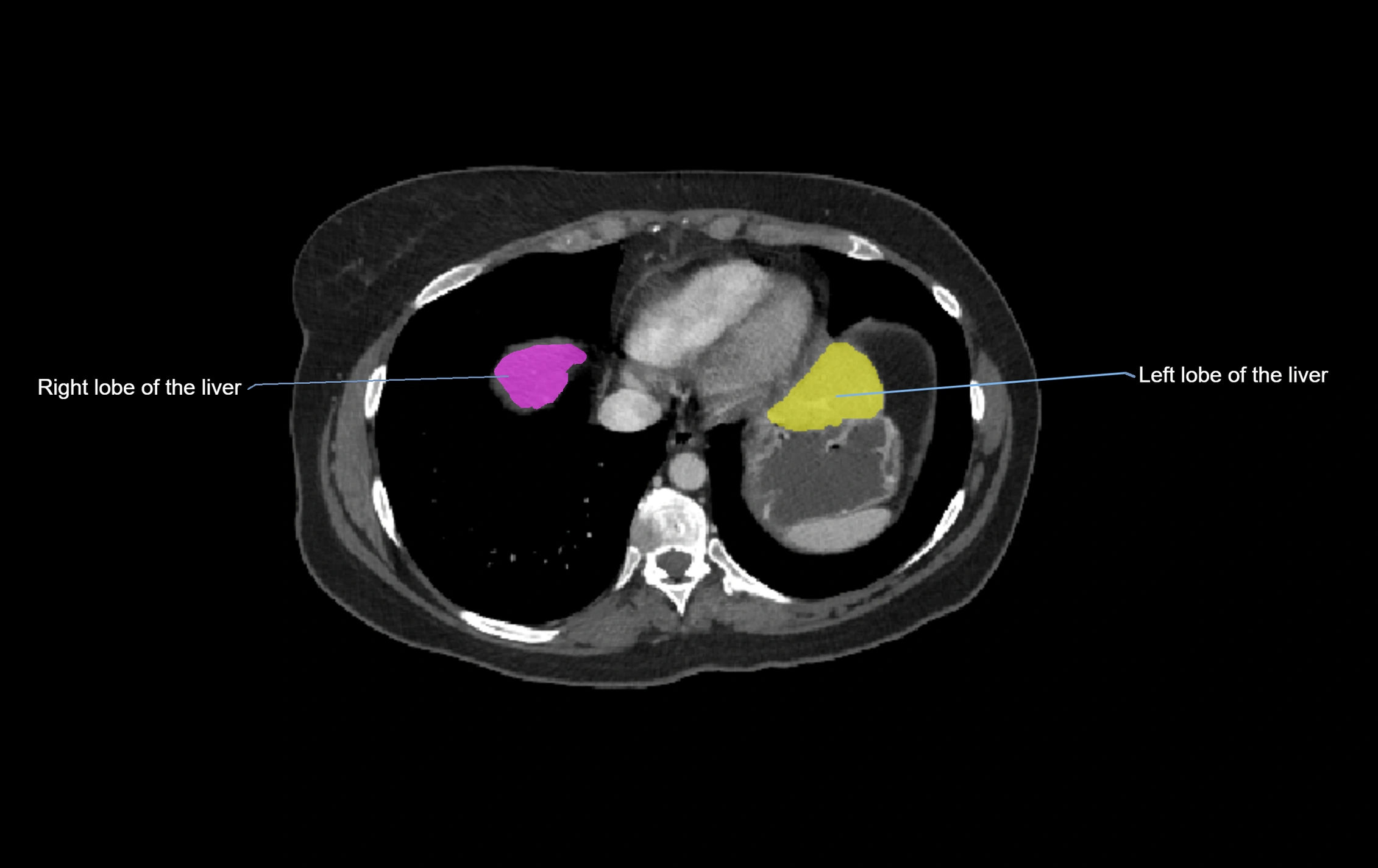 CT lliver lobes axial cross sectional anatomy labelled image -00075.webp
